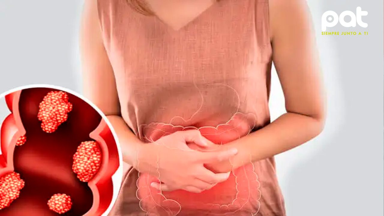 Cáncer de colon en adultos jóvenes: señales de alerta y prevención temprana