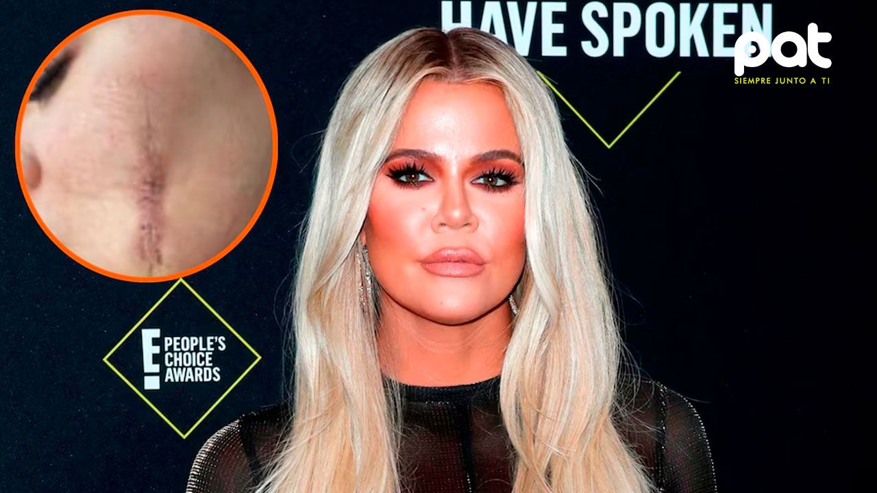 Khloé Kardashian revela las secuelas de su cirugía por cáncer de piel