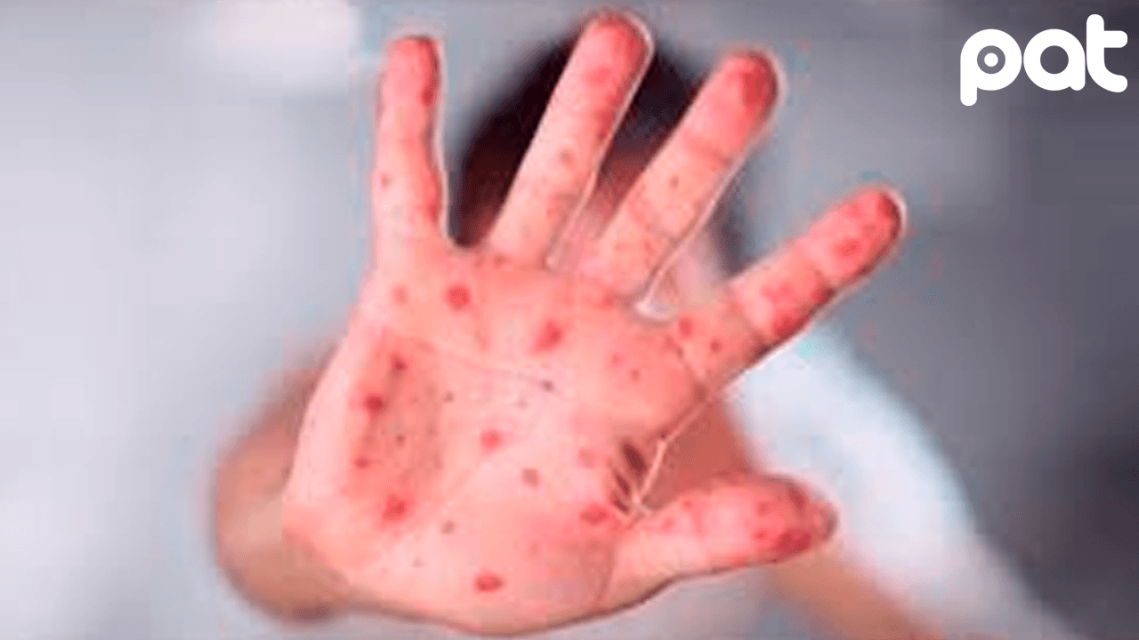 Santa Cruz en alerta por brote de coqueluche y sarampión