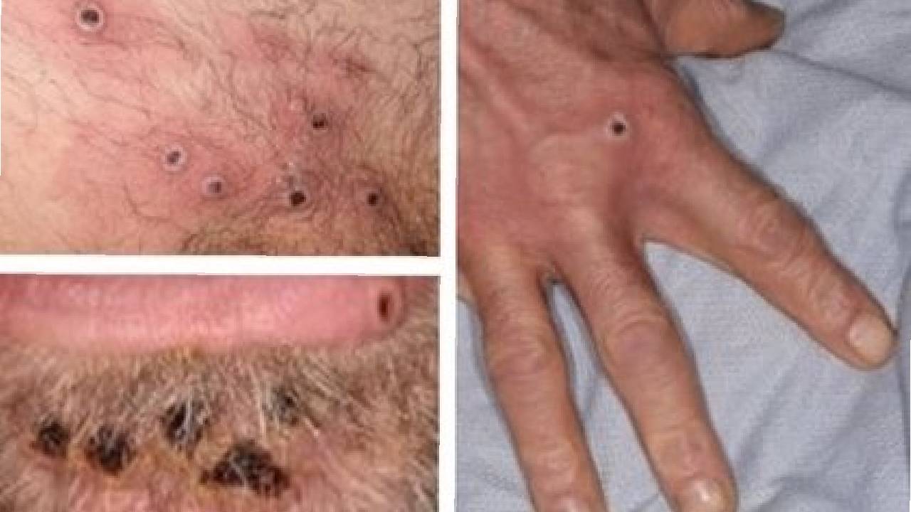 La OMS confirmó más de 1.000 casos de viruela del mono y tres nuevas muertes en el último mes