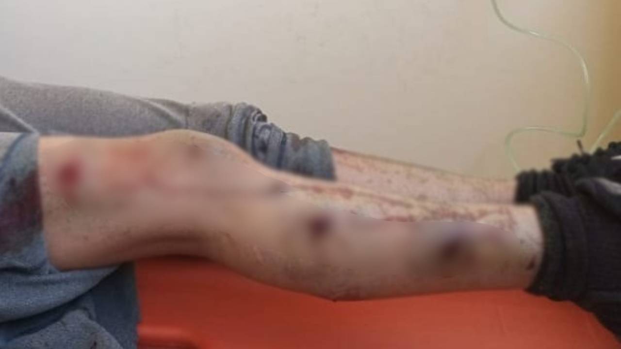 Mujer de 45 años sobrevive a feroz ataque de jauría de perros en Oruro