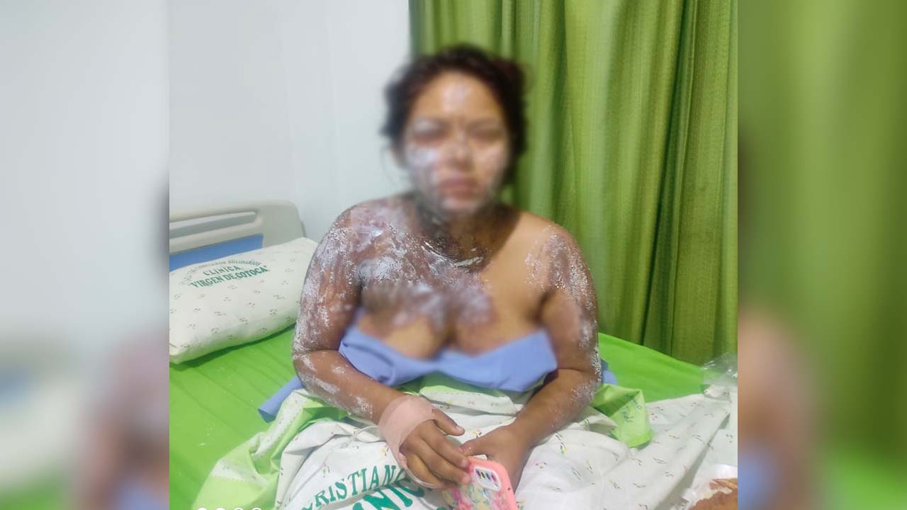 Ataque con ácido por celos: Joven madre víctima de brutal agresión de su vecina
